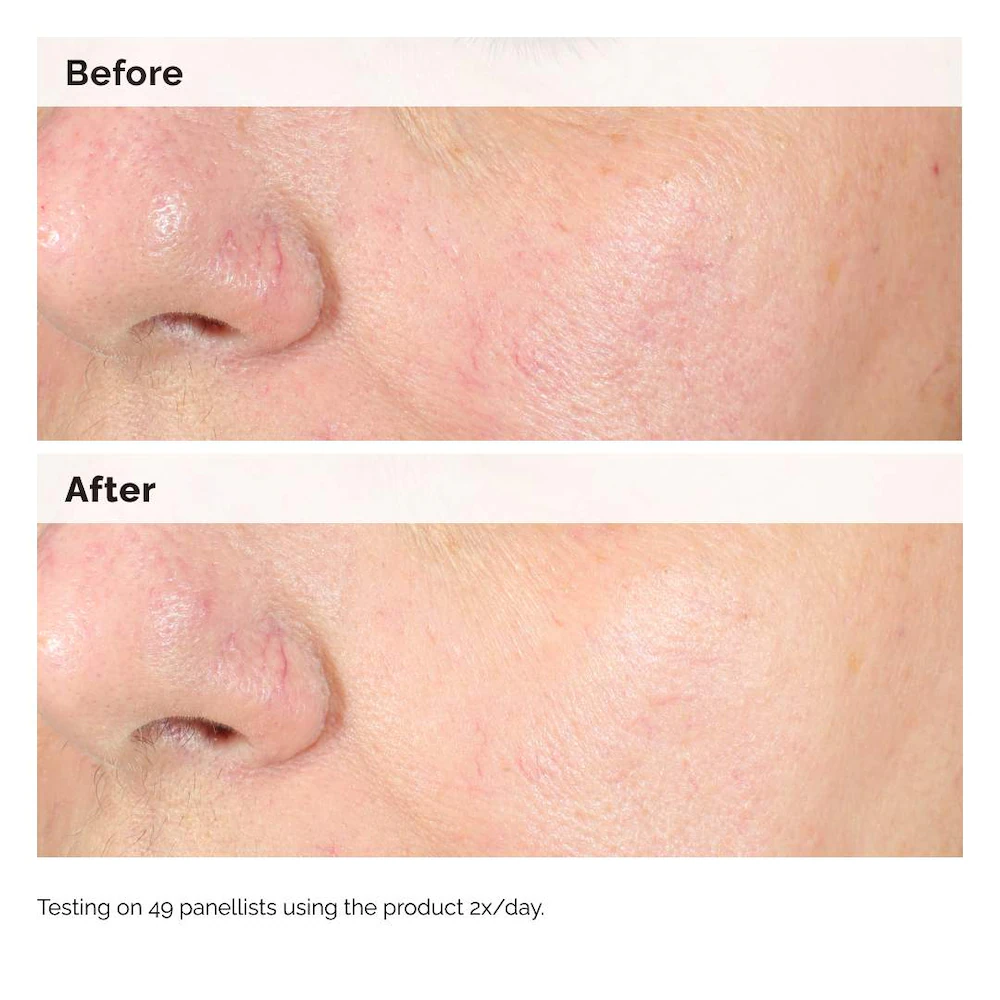 Hyaluronic Acid for Hyperpigmentation - Image 3